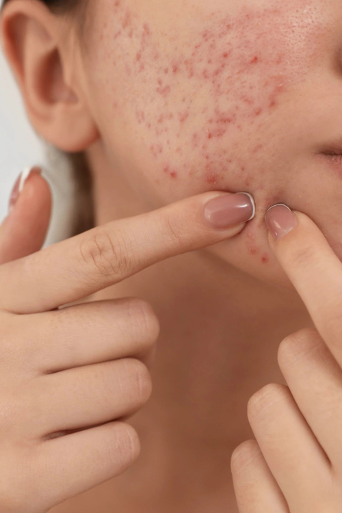 acne